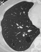 嚢胞性肺疾患の代表的画像11枚目