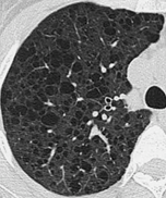 嚢胞性肺疾患の代表的画像2枚目
