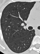 嚢胞性肺疾患の代表的画像3枚目