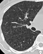 嚢胞性肺疾患の代表的画像4枚目