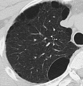 嚢胞性肺疾患の代表的画像5枚目