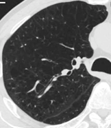 嚢胞性肺疾患の代表的画像6枚目