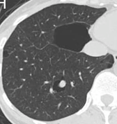 嚢胞性肺疾患の代表的画像8枚目