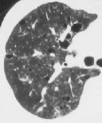 嚢胞性肺疾患の代表的画像9枚目